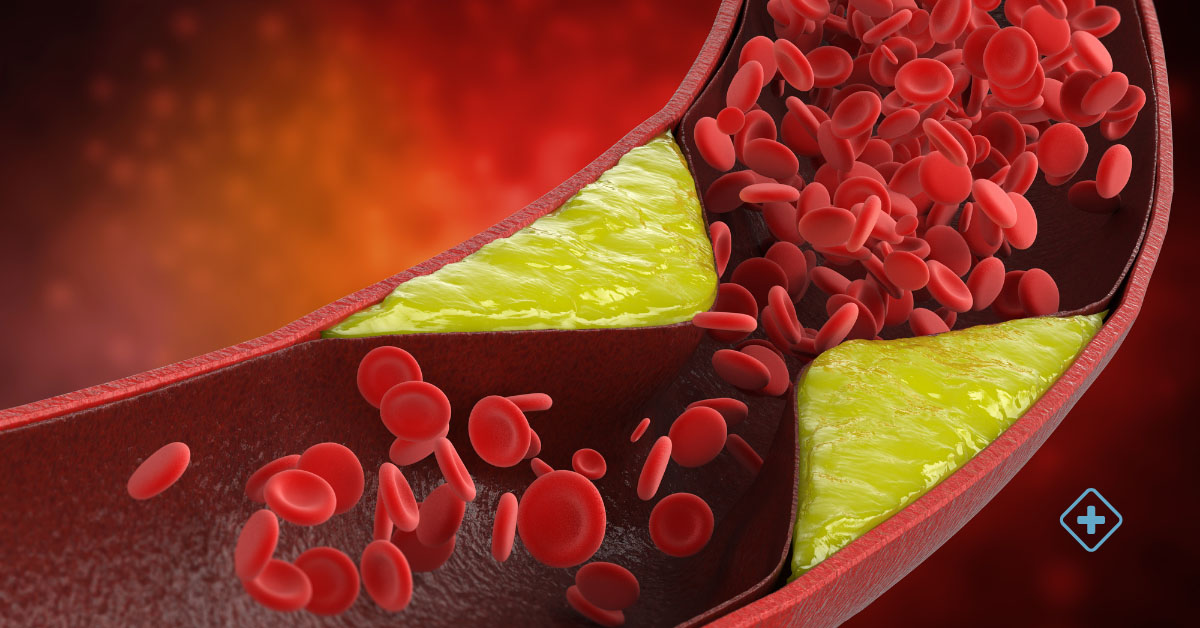 Atherosclerosis: What is it?